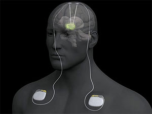 Tratamientos médicos para estimulación neuronal