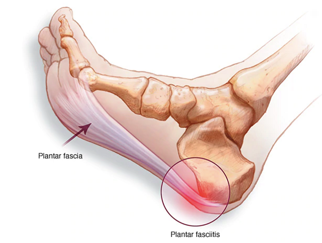 Pie de foto: Muestra de fascitis plantar