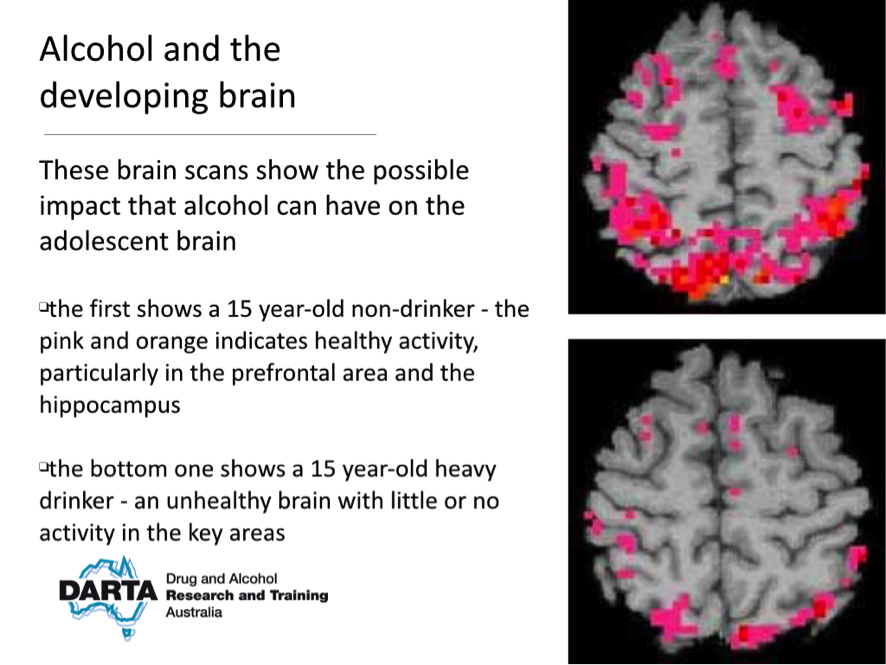 Neuronas dañadas por alcohol