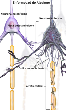 Neuronas afectadas por Alzheimer