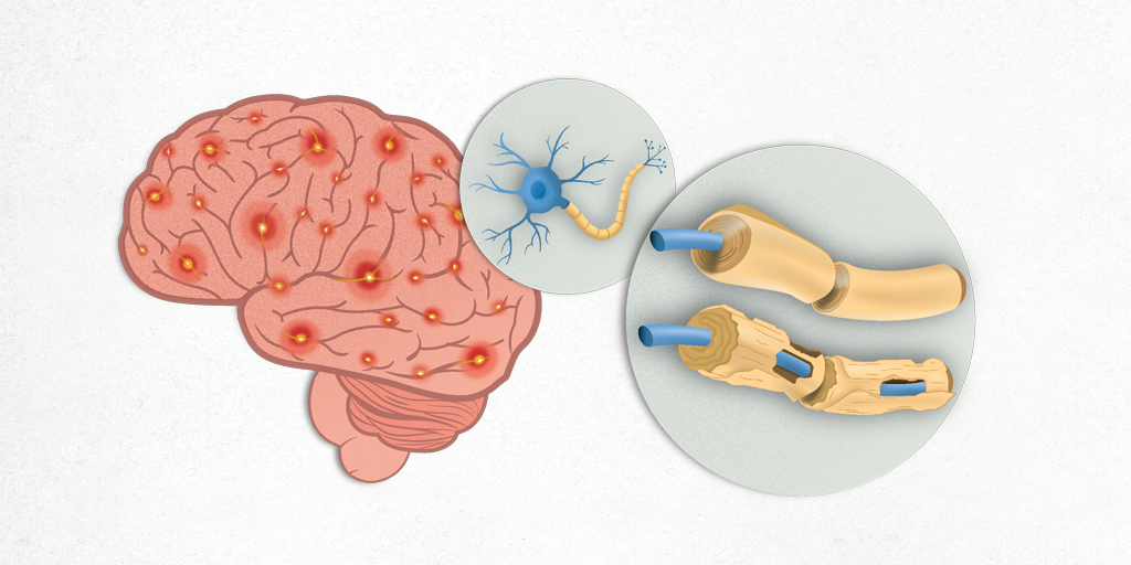 Esclerosis múltiple en cerebro