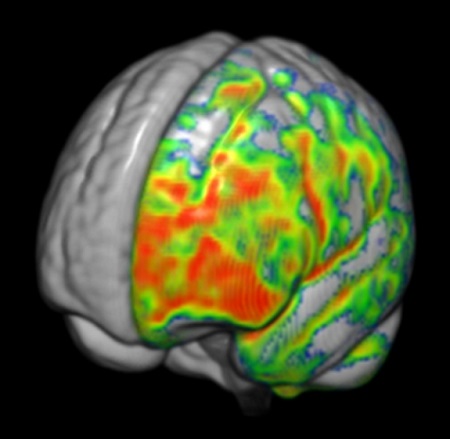 Cerebro y audición en simetría