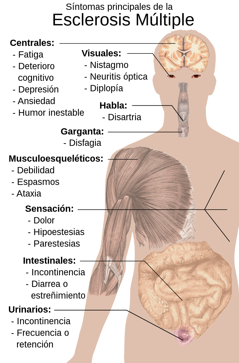 Tratamientos existentes para esclerosis múltiple