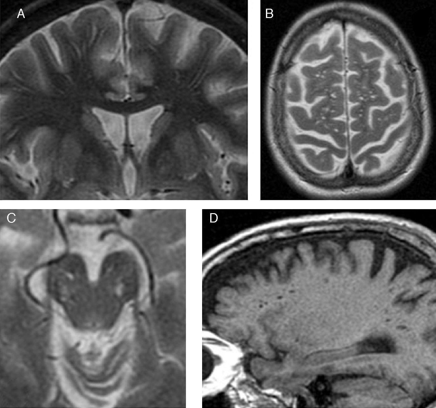 Dilatación perivascular: tratamientos efectivos