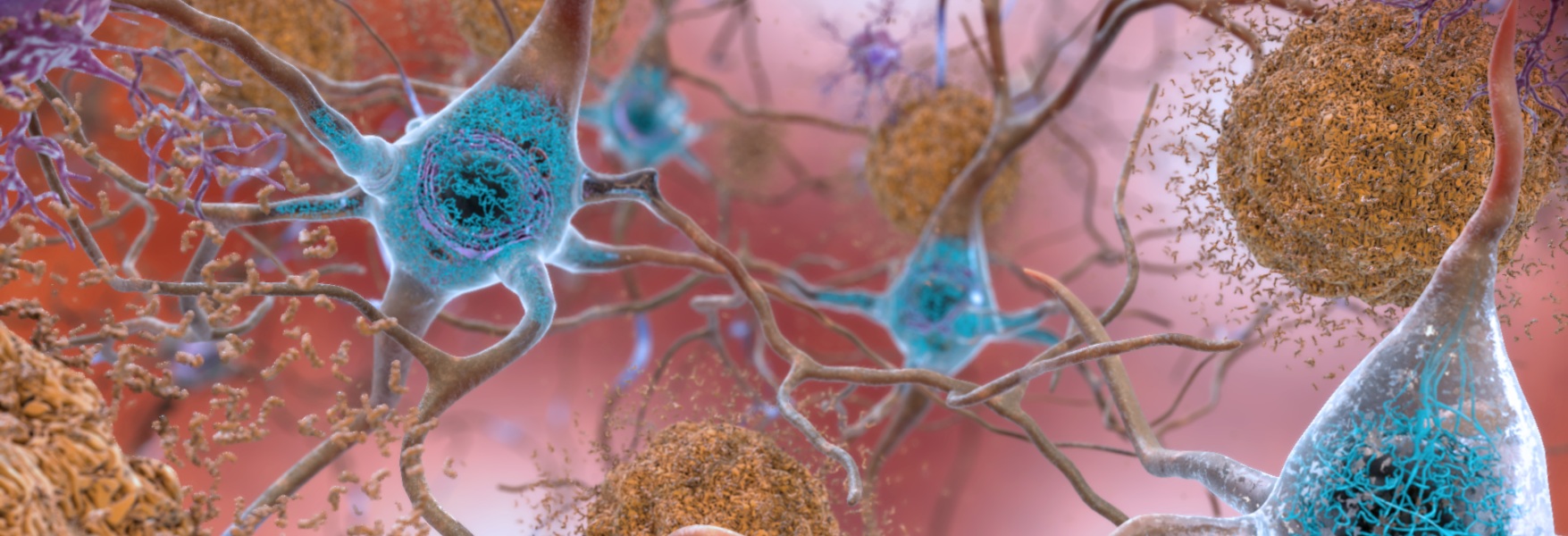 Neuronas afectadas por el Alzheimer