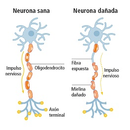 Neuronas afectadas por enfermedades