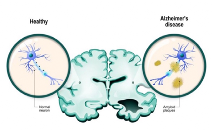 Tratamiento de enfermedades neurodegenerativas