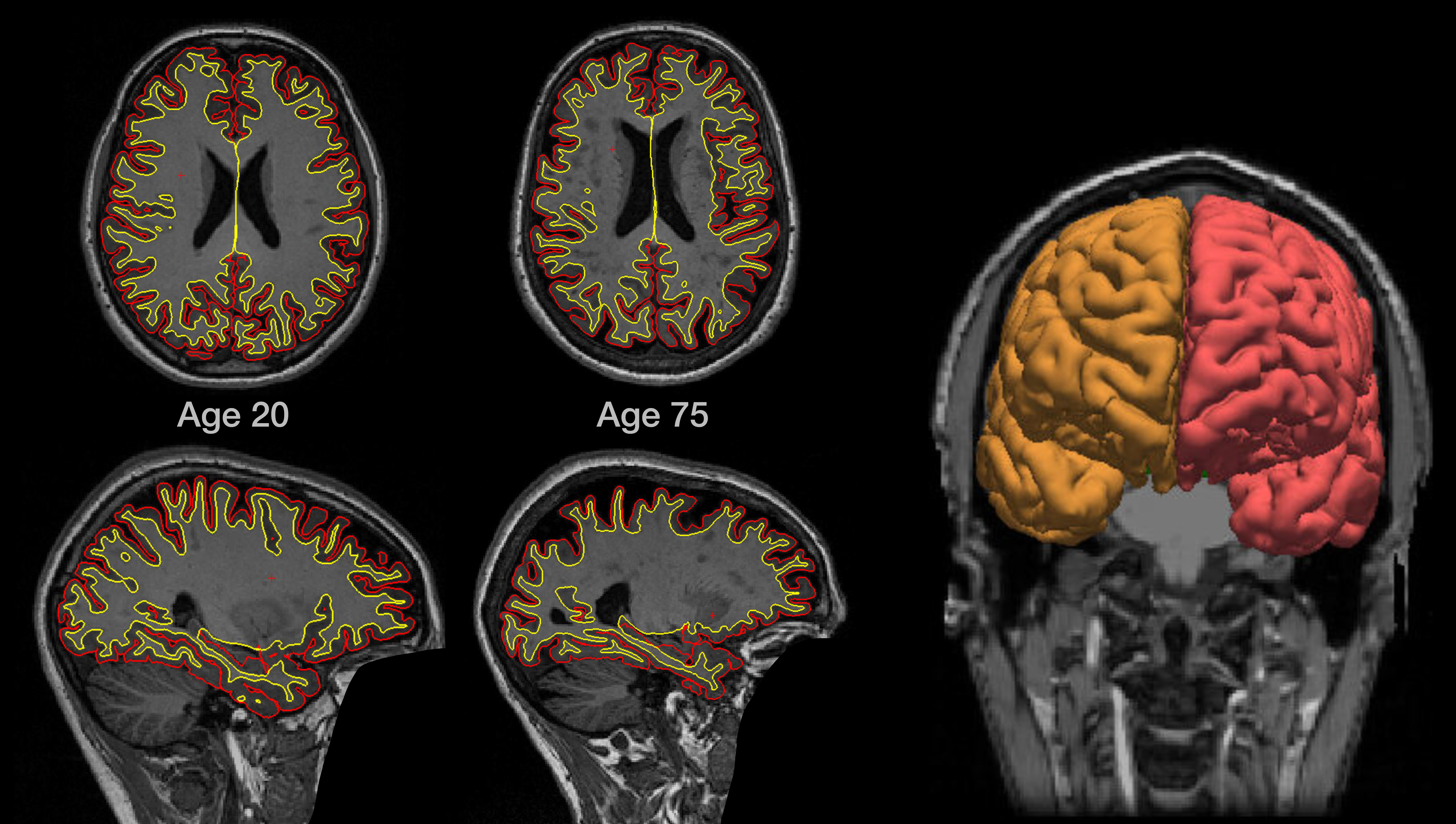 Cerebro envejecido y saludable