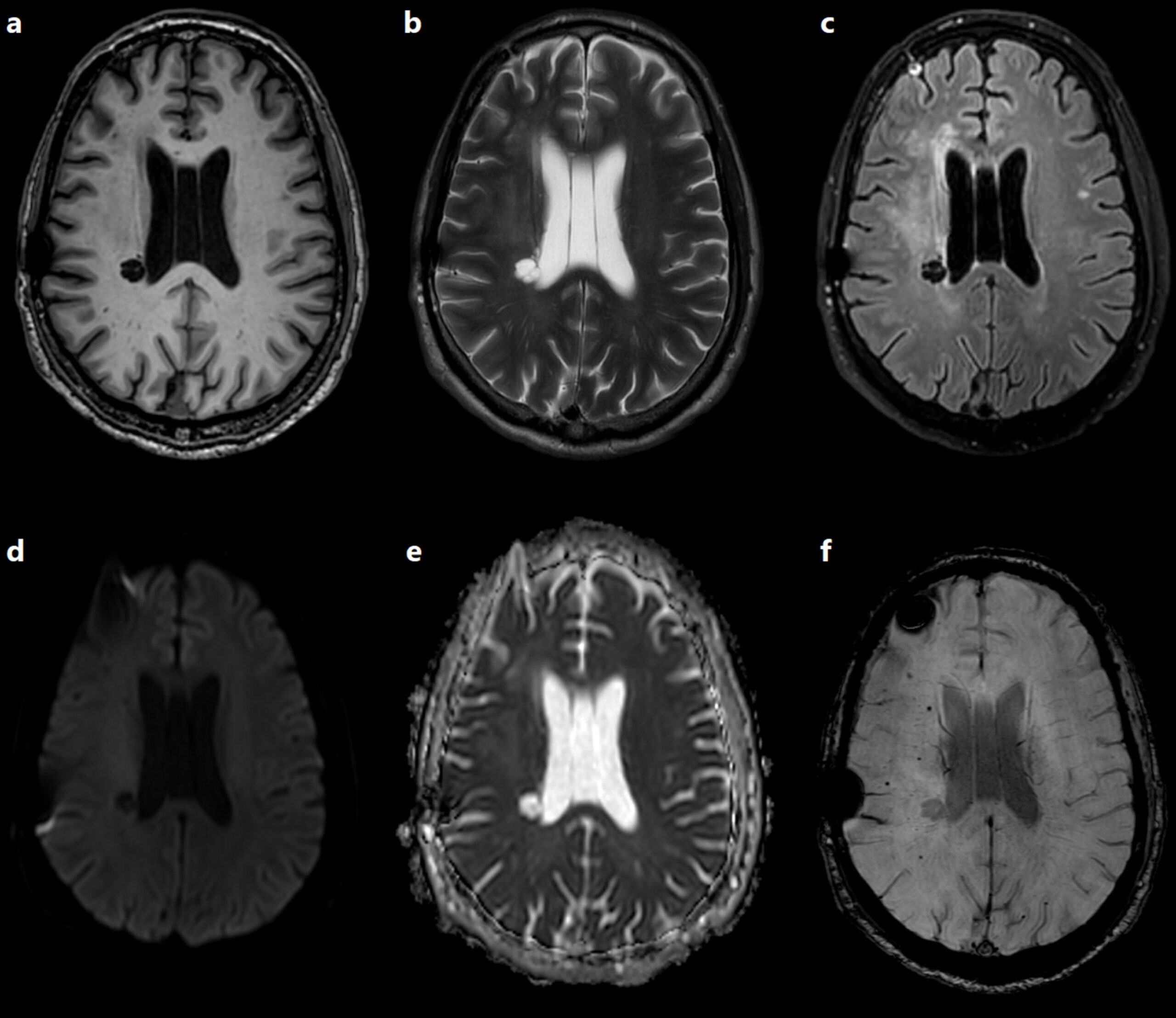 Espacios perivasculares dilatados en cerebro