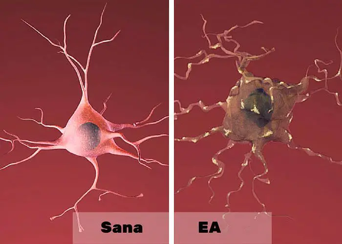 Neuronas sanas y enfermas