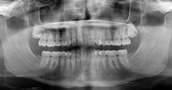 Radiografía dental antes y después