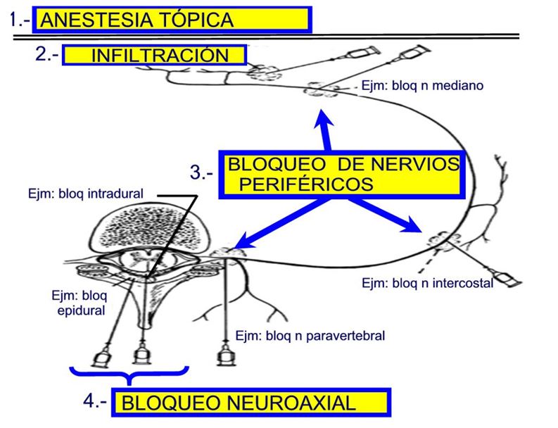 Aplicaciones prácticas del bloqueo neural