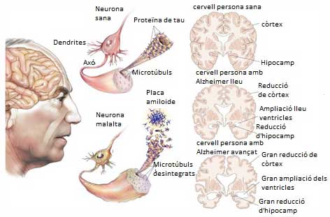 Neuronas afectadas por Alzheimer