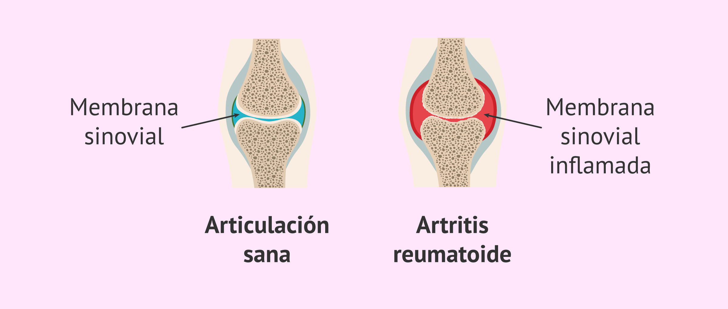 Artritis y fotobiomodulación juntos