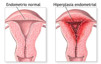 Endometrio y biopsia