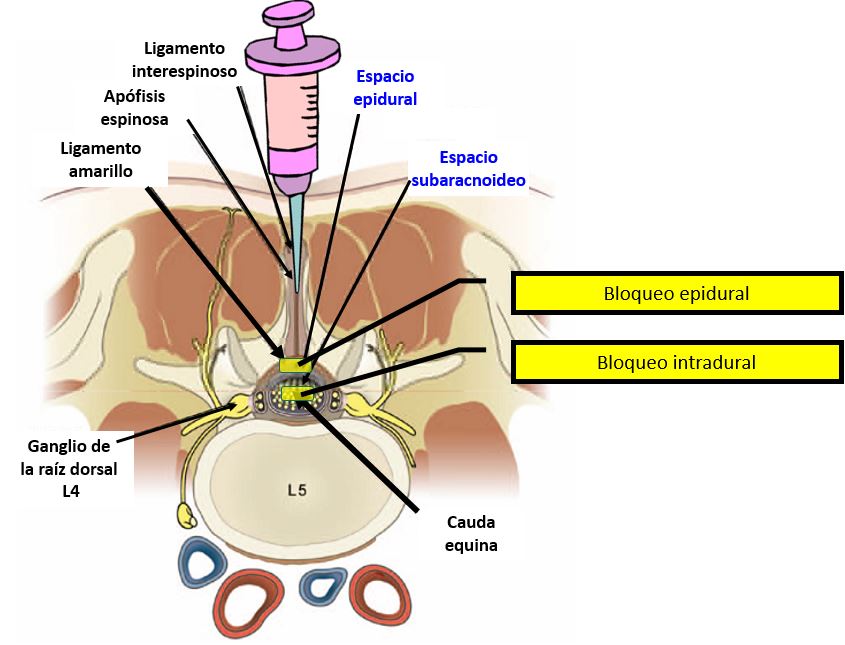 Bloqueo neural y alternativas