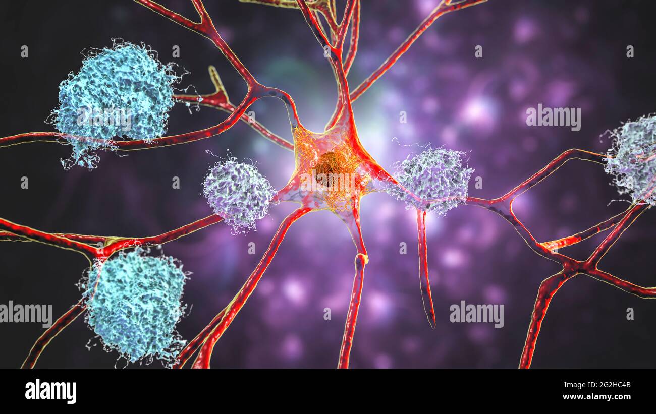 Neuronas dañadas por el Alzheimer