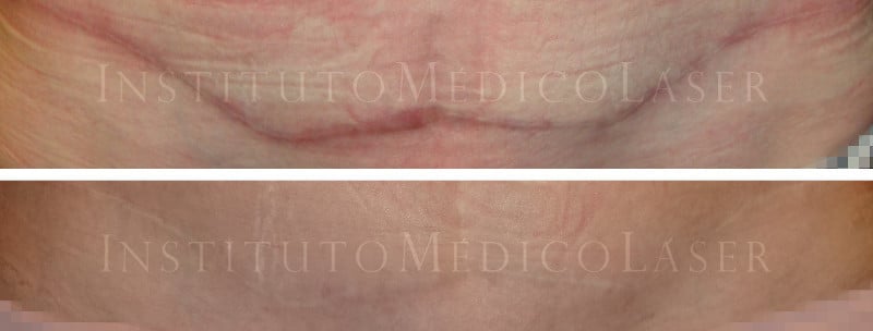 Cicatrices tratadas con fotobiomodulación
