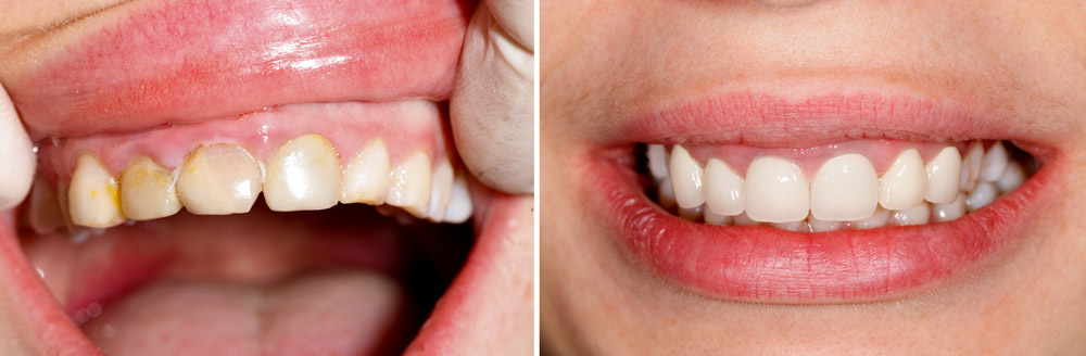 Sonrisa antes y después