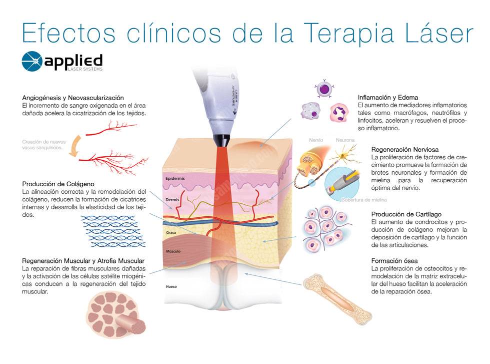 Terapia láser en acción