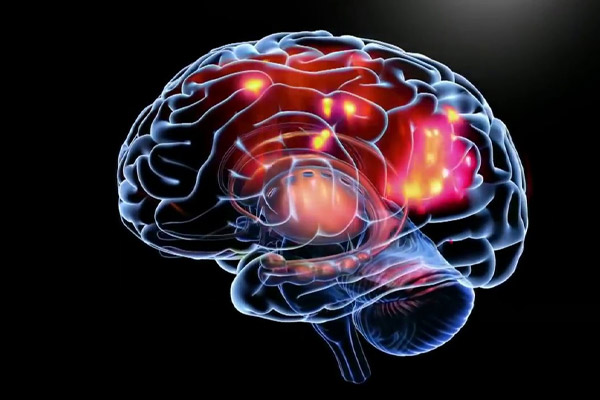 Cerebro afectado durante convulsiones