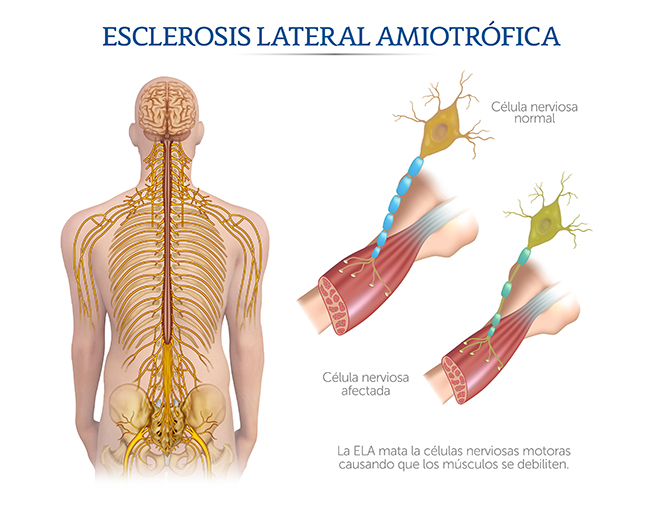 ELA y sistema nervioso