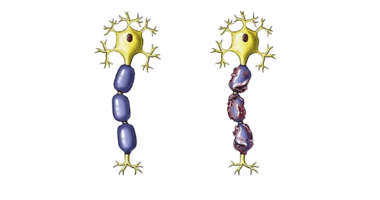Desmielinización y sistema nervioso