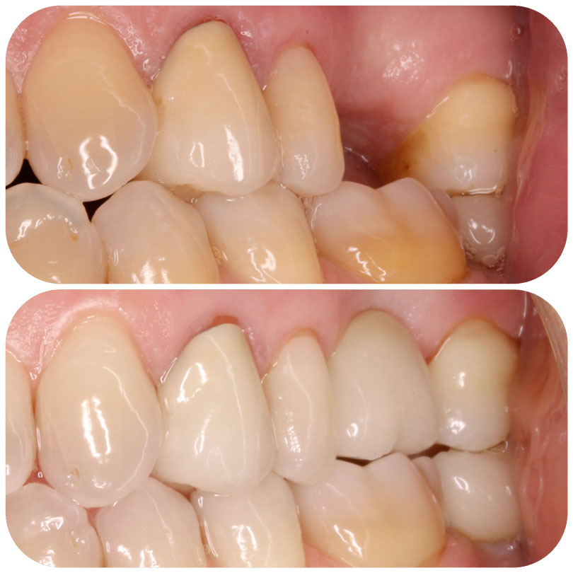 Comparativa de tratamientos dentales