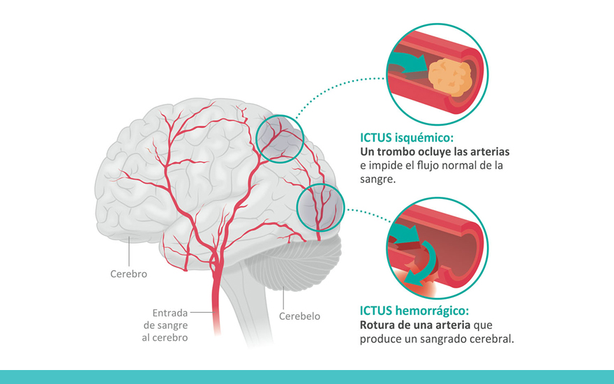 Tabaco y enfermedades neurodegenerativas