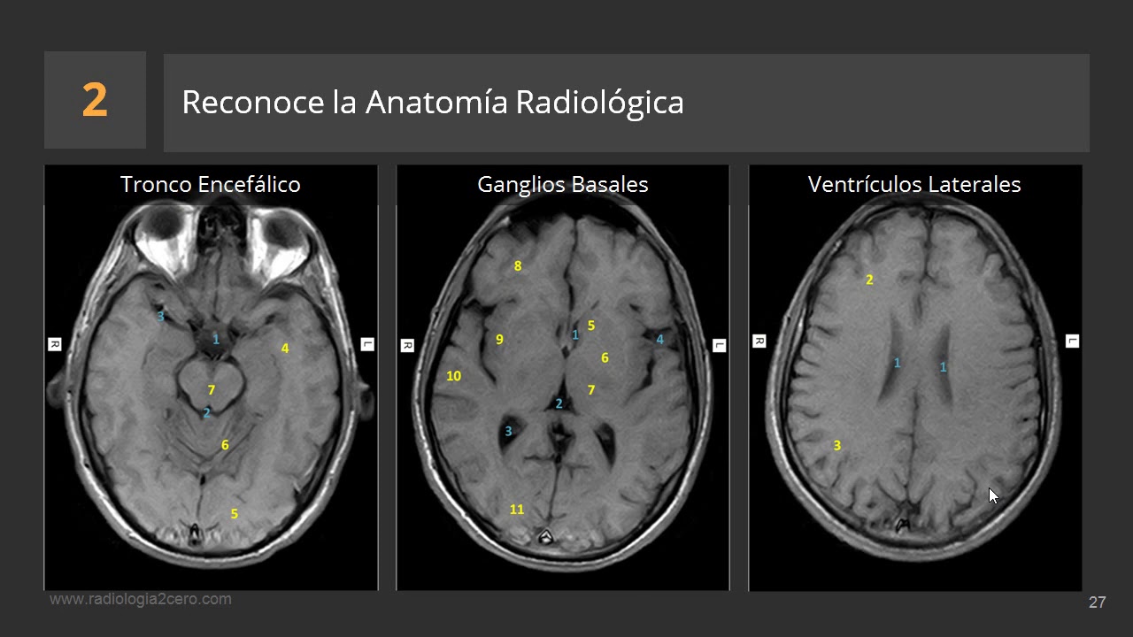 Resonancia magnética cerebral