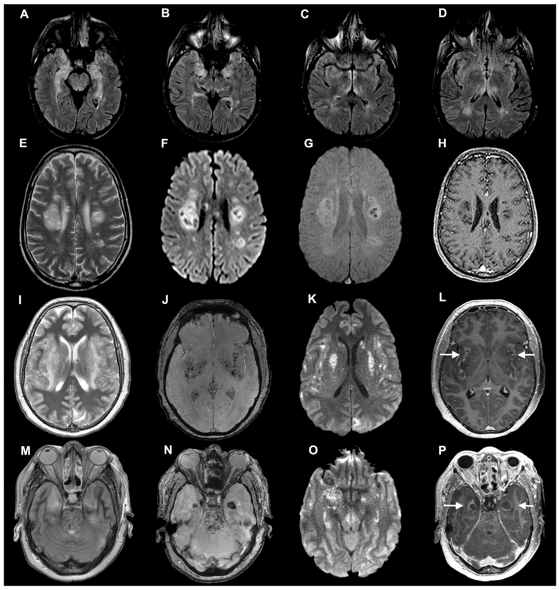 Lesiones cerebrales y neuronas afectadas