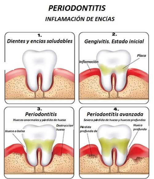 Riesgos asociados con fotobiomodulación dental