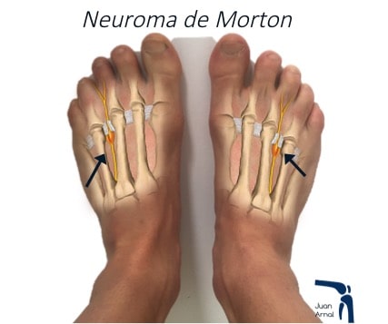 Neuronas de Morton reveladoras