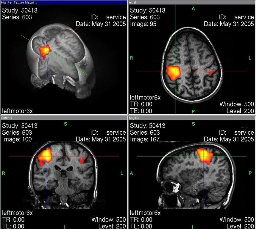 Comparación de la actividad neuronal