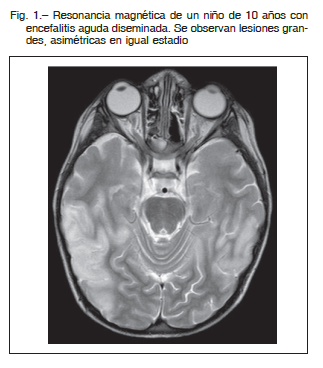 Lesiones desmielinizantes cerebrales